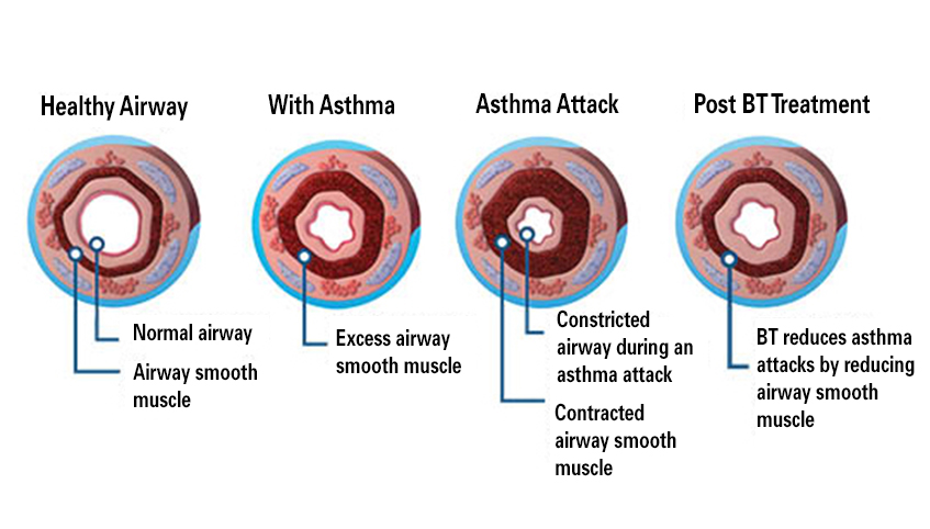 Brochial Thermoplasty chart