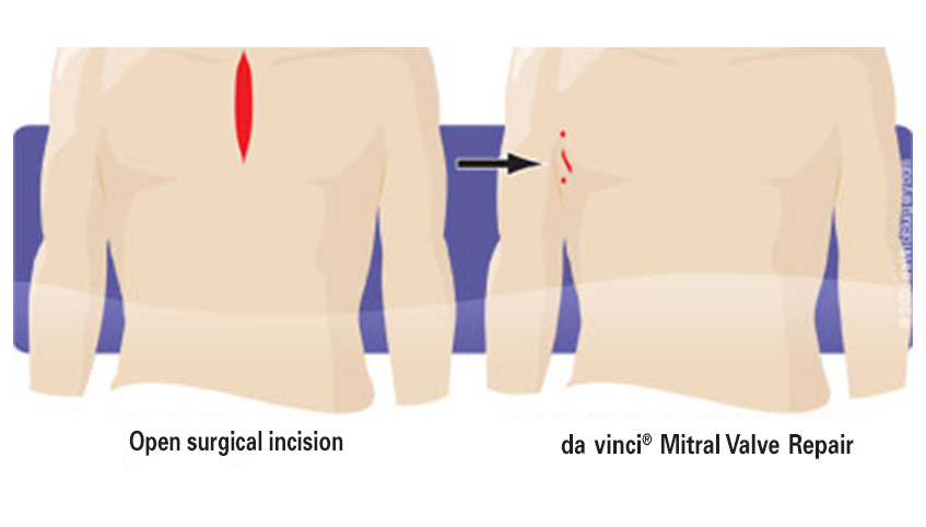 Da Vinci mitral valve repair