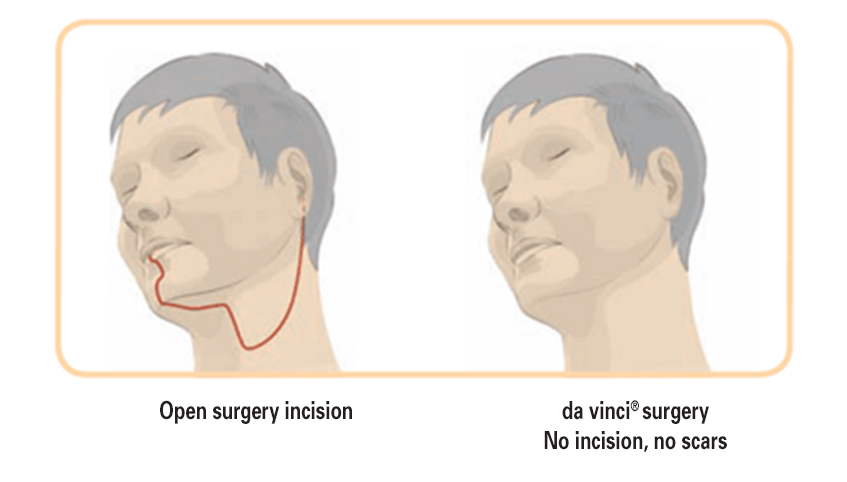 da vinci head and neck surgery