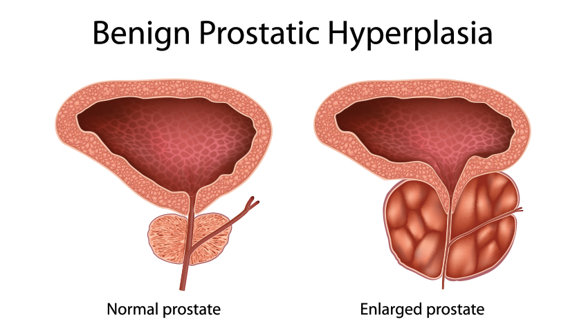 Benign Prostatic Hyperplasia