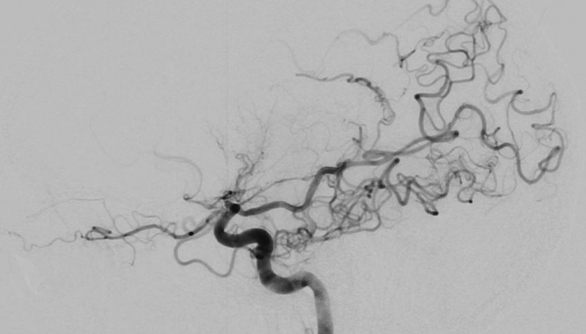 MoyaMoya procedure