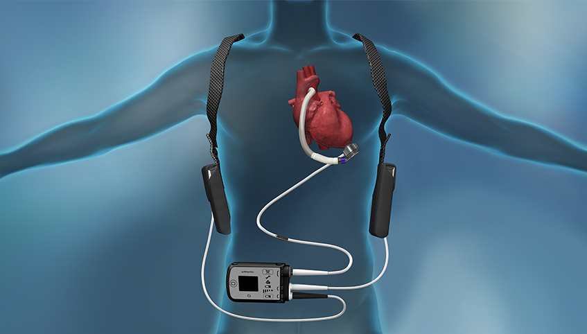 Image of HeartMate 3™ device
