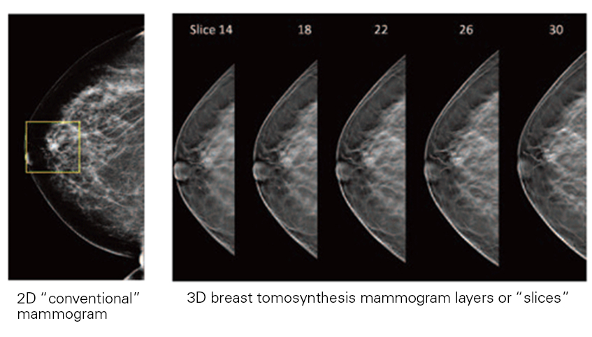 Mammogram images that compare 2D versus 3D.