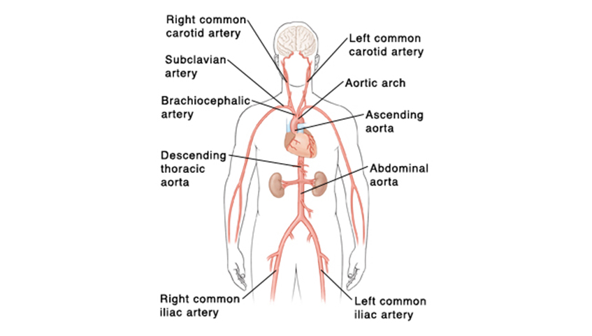 Abdominal aortic aneurysm graphic