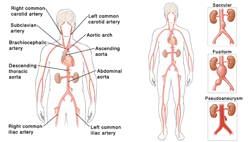 Abdominal Aortic Aneurysm The University Of Kansas Health System
