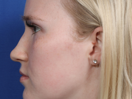 Before and after photos rhinoplasty | Kansas City