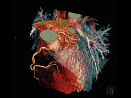 Image capture from the SOMATOM® Definition Flash which allows for a more accurate diagnosis.