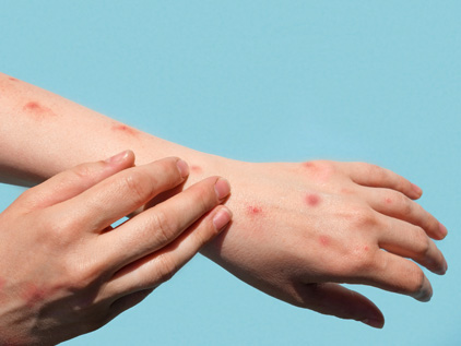 Hands with monkeypox rash symptoms