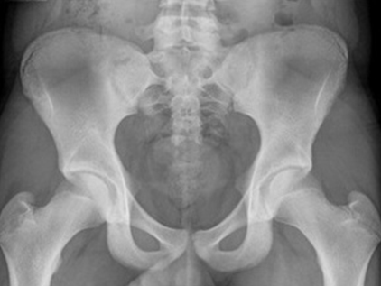 X-ray of hips