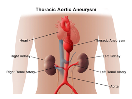 Thoracic aortic aneurysm graphic