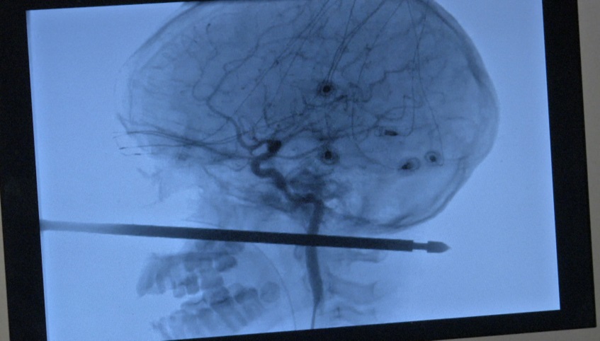 An image shows the skewer that was lodged in Xavier Cunningham's cheek