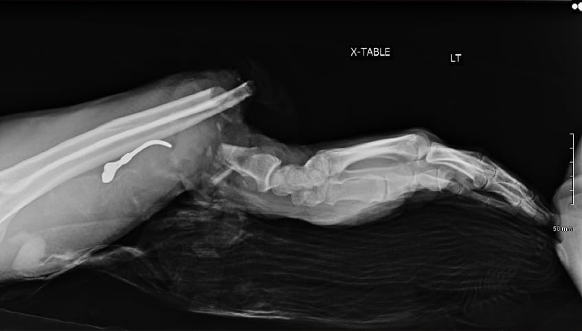 Steve Pelgrin pre surgery x-ray