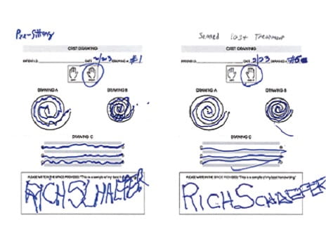 A side by side comparison shows the difference Rich Schaefer experienced in controlling his tremor following noninvasive neurosurgery, Exablate Neuro.