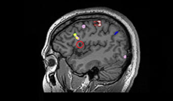 Joe Dwyer - Epilepsy