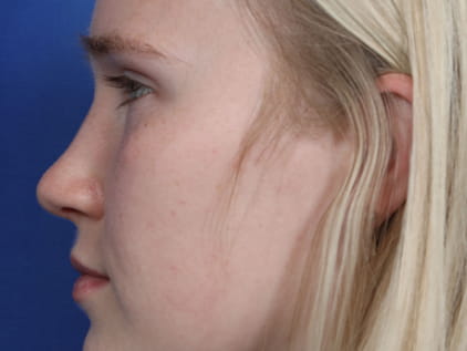 Nose Job | Kansas City