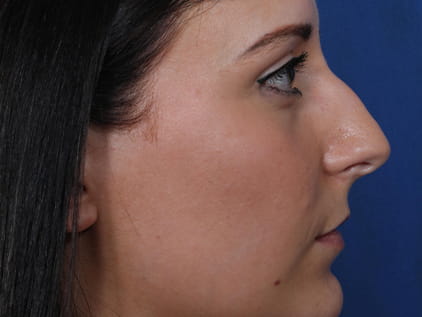 Rhinoplasty by Dr. Humphrey – Pre-Op