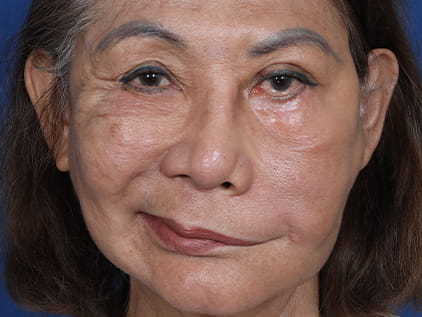 Bilateral brow-lift by Dr. Humphrey - Pre-Op