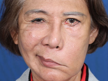 Bilateral brow-lift by Dr. Humphrey - Pre-Op