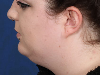 Deep neck lift by Dr. Humphrey – Post-Op