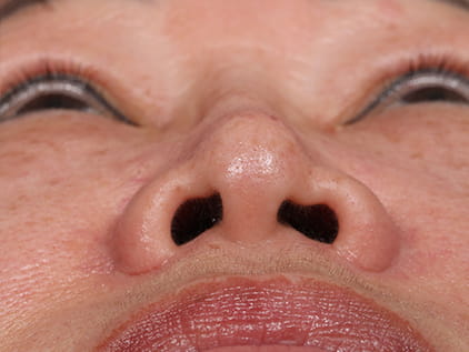 Rhinoplasty by Dr. Humphrey – Pre-Op