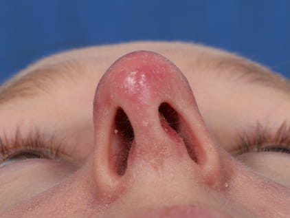 Nose job surgery | Average cost in Kansas City