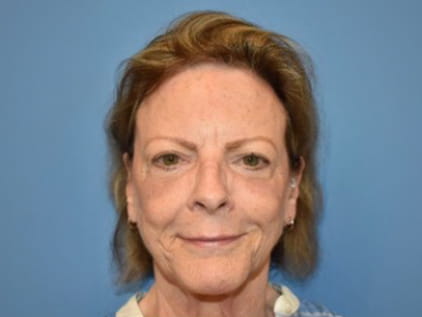 After plastic surgery procedure