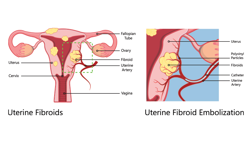 Uterine Fibriods